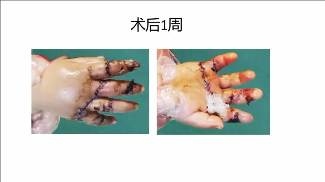 聚焦顯微外科|葫蘆島市醫(yī)學會顯微外科學分會第一屆第二次學術會議順利召開(圖25)